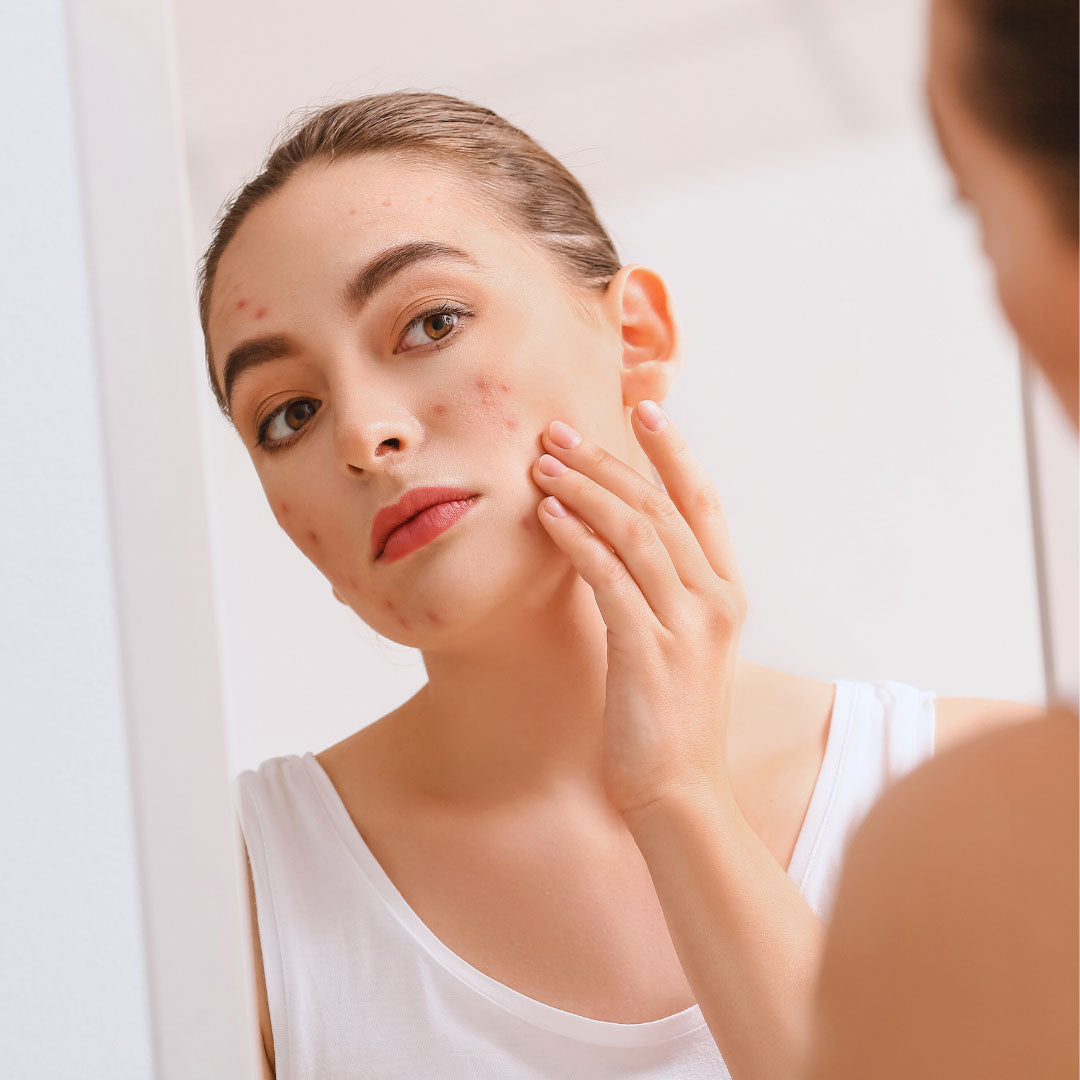 Woman having an acne breakout - how to get rid of acne fast at home