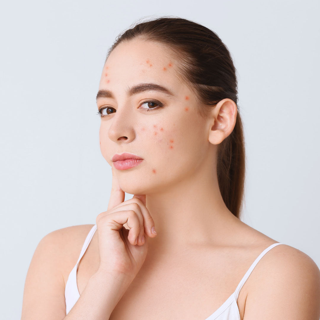 The Best Skin Care Routine for Acne-prone Sensitive Skin